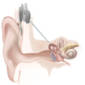 New Sound Filter Created for Cochlear Implants