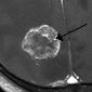 New Therapy Avoids Brain Cancer Recurrence
