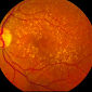 New Therapy Developed Against Macular Degeneration