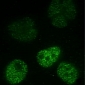 Nickel Nanoparticles Favor Development of Cancer