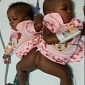 Nigerian Twins Joined at the Hip Are Separated in India