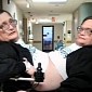 Ohio Brothers Stand to Become the World's Oldest Conjoined Twins