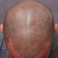 Parlor Comes Up with Cure for Baldness – the Hair Tattoo
