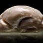 Picture of the Day: Weirdest Human Brain Ever Is Entirely Smooth, Has No Ridges and Folds