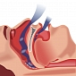 Reducing Obstructive Sleep Apnea with Low-Tech Means