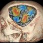 Removing Bits of Skull Enhances Brain Imaging