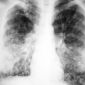 Researchers Discover An Efficient and Inexpensive Weapon Against Cystic Fibrosis