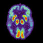 Rewiring the Brain Prevents Onset of Alzheimer’s