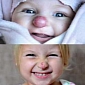 Rudolf-like Red Tumor Removed from Little Girl's Nose