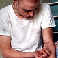 Russia’s Deadliest Drug Turns Skin Scaly