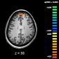 Schizophrenia Has Been Linked to Sound Processing