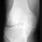 Selenium Linked to Knee Osteoarthritis