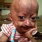 Six-Year-Old with Premature Aging Condition Supports Fundraiser for Progeria