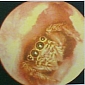 Spider Crawls Inside a Woman's Ear, Spends 5 Days in Her Canal