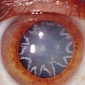 Star-Shaped Cataract Developed by Man Who Got Electrocuted