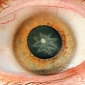 Star-Shaped Cataract Developed by Man Who Got Punched in the Eye
