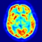 Structural Abnormalities Found in the Brains of Psychopaths
