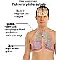 Study: Tuberculosis Patients Have Higher Lung Cancer Risk