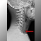 Teen Inhales Blowdart, Parents Find Out upon Seeing X-Rays