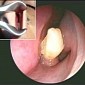 Terribly Confused Tooth Grows Inside Man's Nose