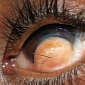 The Hairy Eyeball – Rare Tumor Causes Man to Grow Hair on His Eyeball