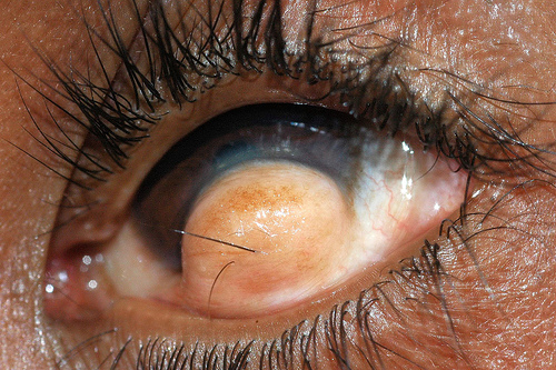 The Hairy Eyeball – Rare Tumor Causes Man to Grow Hair on His Eyeball