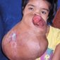 The Largest Female Facial Tumor Ever