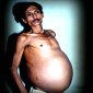 The Man That Carried a Parasite Twin Inside His Stomach for 36 Years!