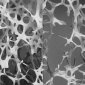The Threat of Osteoporosis