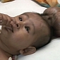 “Two-Headed” Baby Boy Undergoes Life Changing Surgery in India