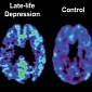 Unique Brain Scan Technique Sees Depression in Seniors