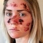 Woman Shares Graphic Skin Cancer Selfie to Warn You Off Tanning Beds - Photo