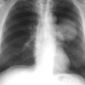 Women with Lung Cancer Live Longer Than Men