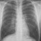 X-Rays Can Detect Lung Cancer in Time
