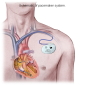 iPods Declared Pacemaker-Friendly Once Again