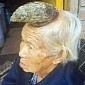 Woman Has 13-Centimeter (5-Inch) Horn Growing on Her Forehead