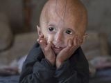 Most progeria sufferers die when about 13 years old