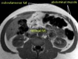 MRI scan through the abdomen showing fat disposal
