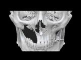 Standard surgery planning model from Osteo3d, front view with broken maxilla