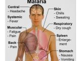 Infographic details the most common malaria symptoms