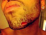 Chris Brown shows off injury sustained in Drake fight in NYC club