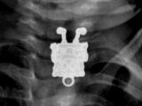 X-ray image shows the pendant swallowed by the toddler
