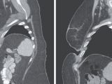Scans show the tumor (left) and the hole left by it (right)