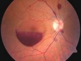 Doctors say the man lost his vision because of a bleeding in front of his retina