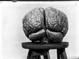 Harvey Cushing forever transformed brain surgery