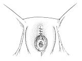 Clitoridectomy drawing