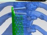 CT scans used to produce a 3D implant