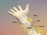Nerves, blood vessels and tendons must all be connected during a hand transplant