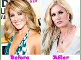 Heidi Montag before the first rhinoplasty and breast implants, and after her 10-surgery marathon