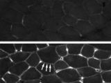 Muscle cells of untreated mice with muscular dystrophy (top) show little utrophin in cell walls. Muscles of mice treated with biglycan (bottom) have accumulated the protein utrophin.